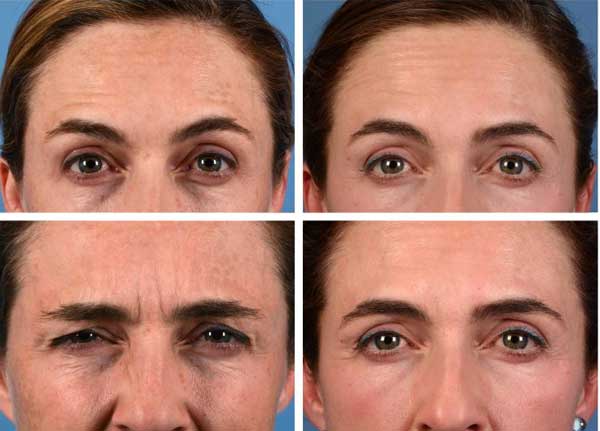 تزریق ژل و بوتاکس در اصفهان