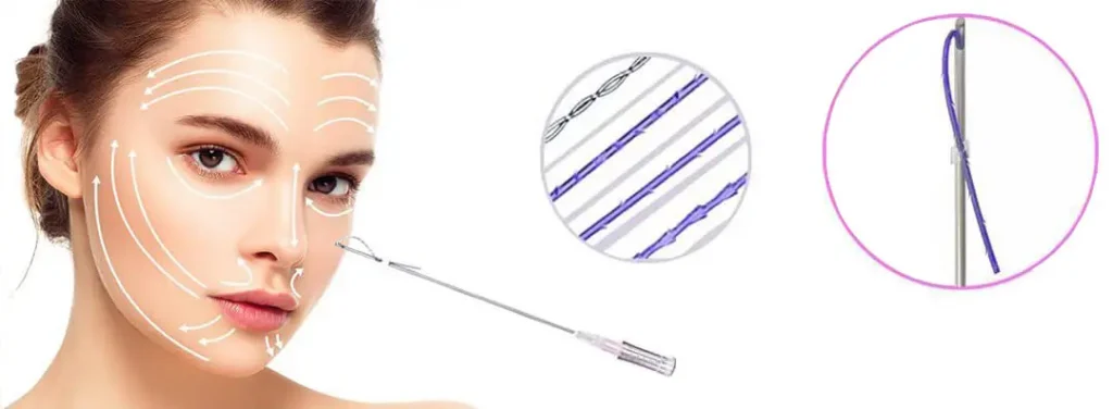 لیفت صورت با نخ در اصفهان