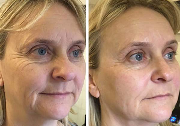 مرکز هایفوتراپی در اصفهان