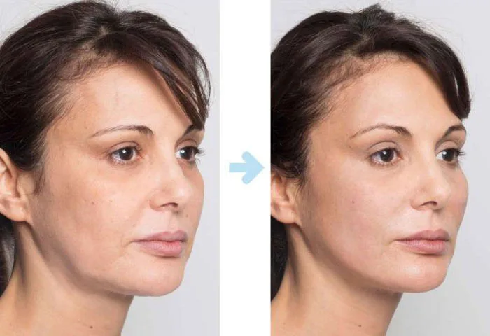 لیفت صورت با نخ در اصفهان