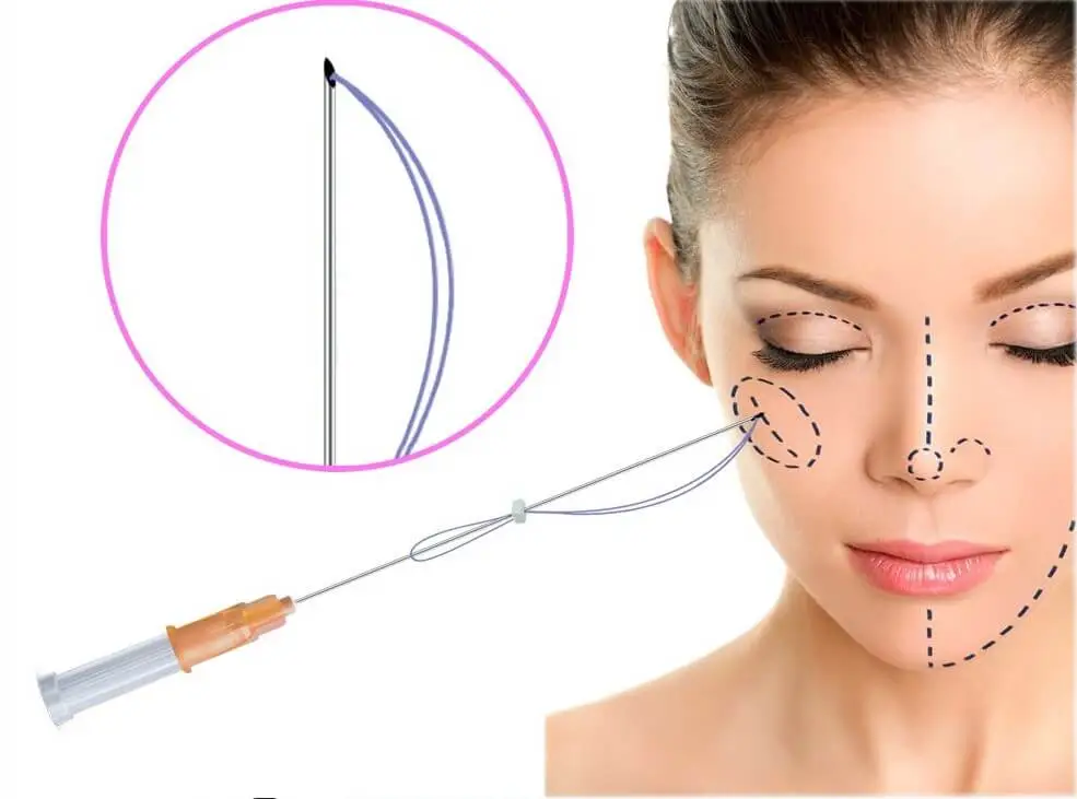 لیفت صورت با نخ در اصفهان