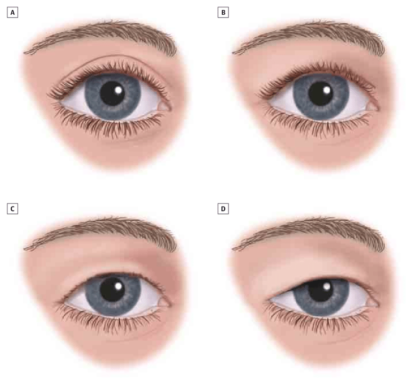 درمان افتادگی پلک در اصفهان