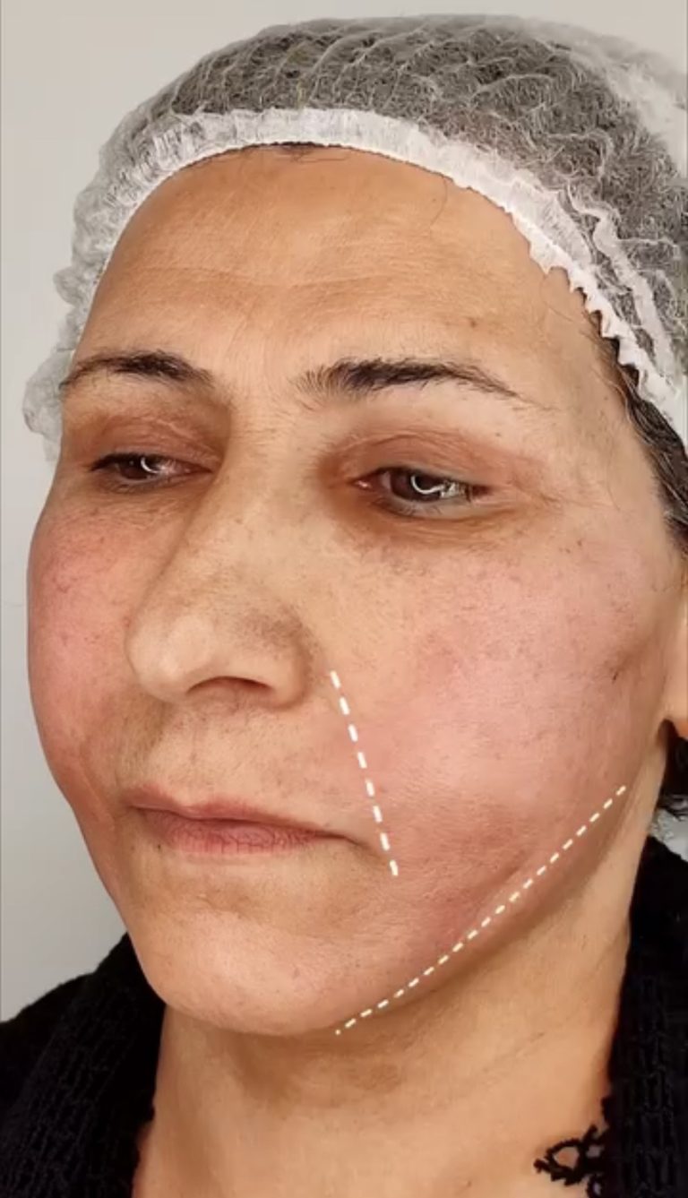 لیفت صورت با نخ در اصفهان