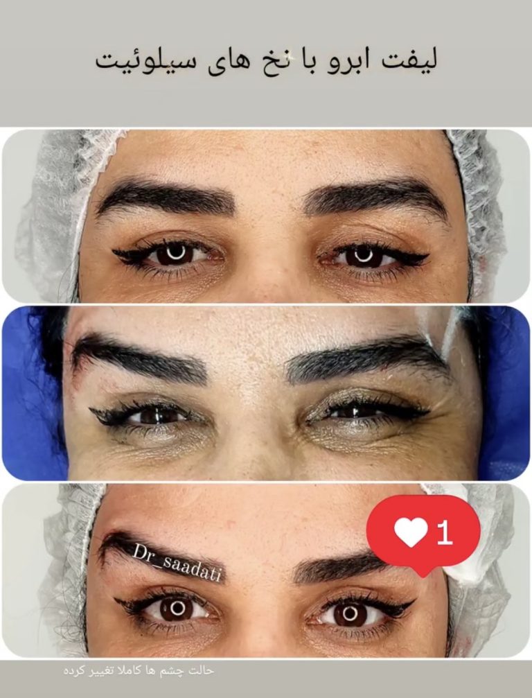 لیفت صورت با نخ در اصفهان