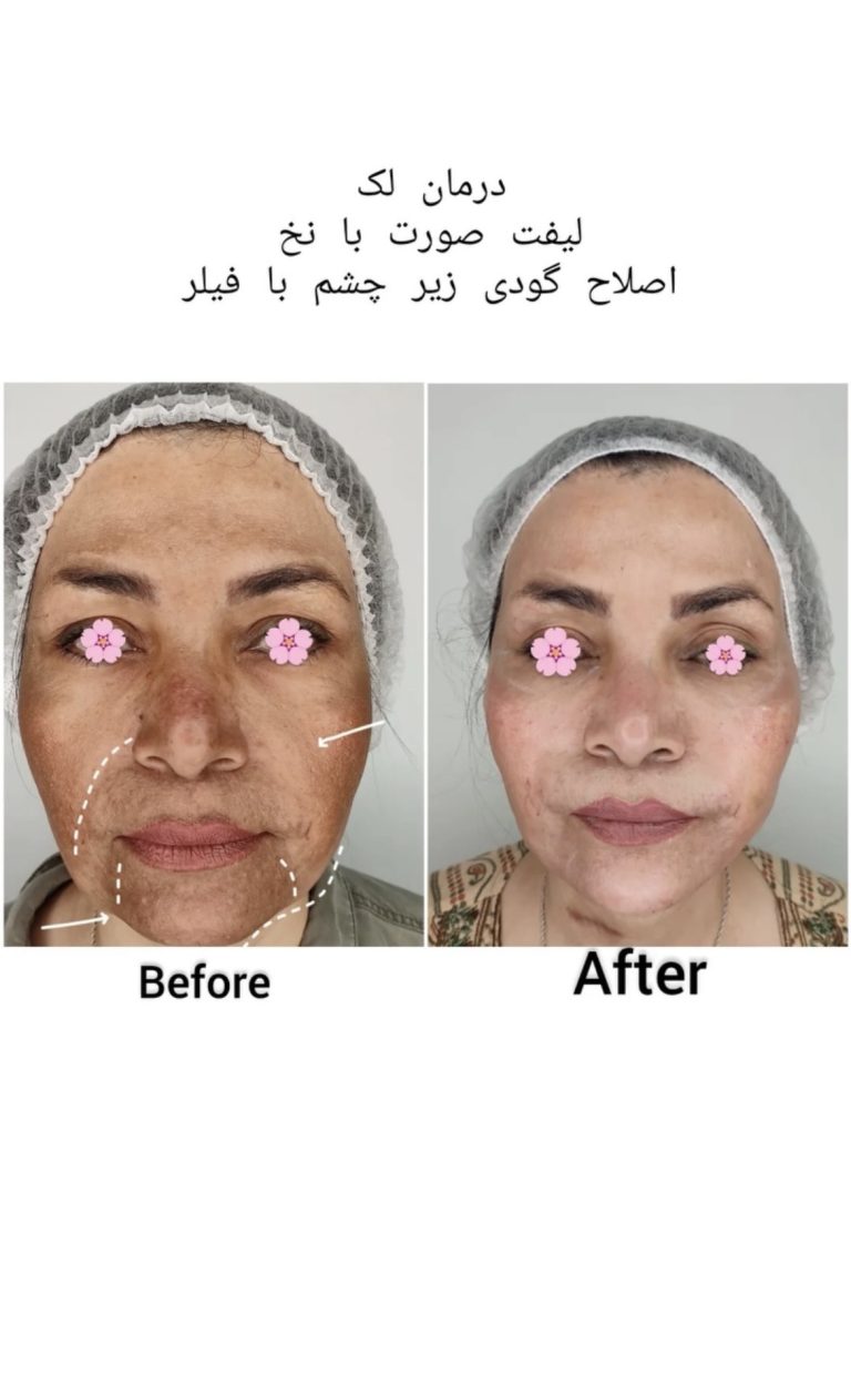 لیفت صورت با نخ در اصفهان