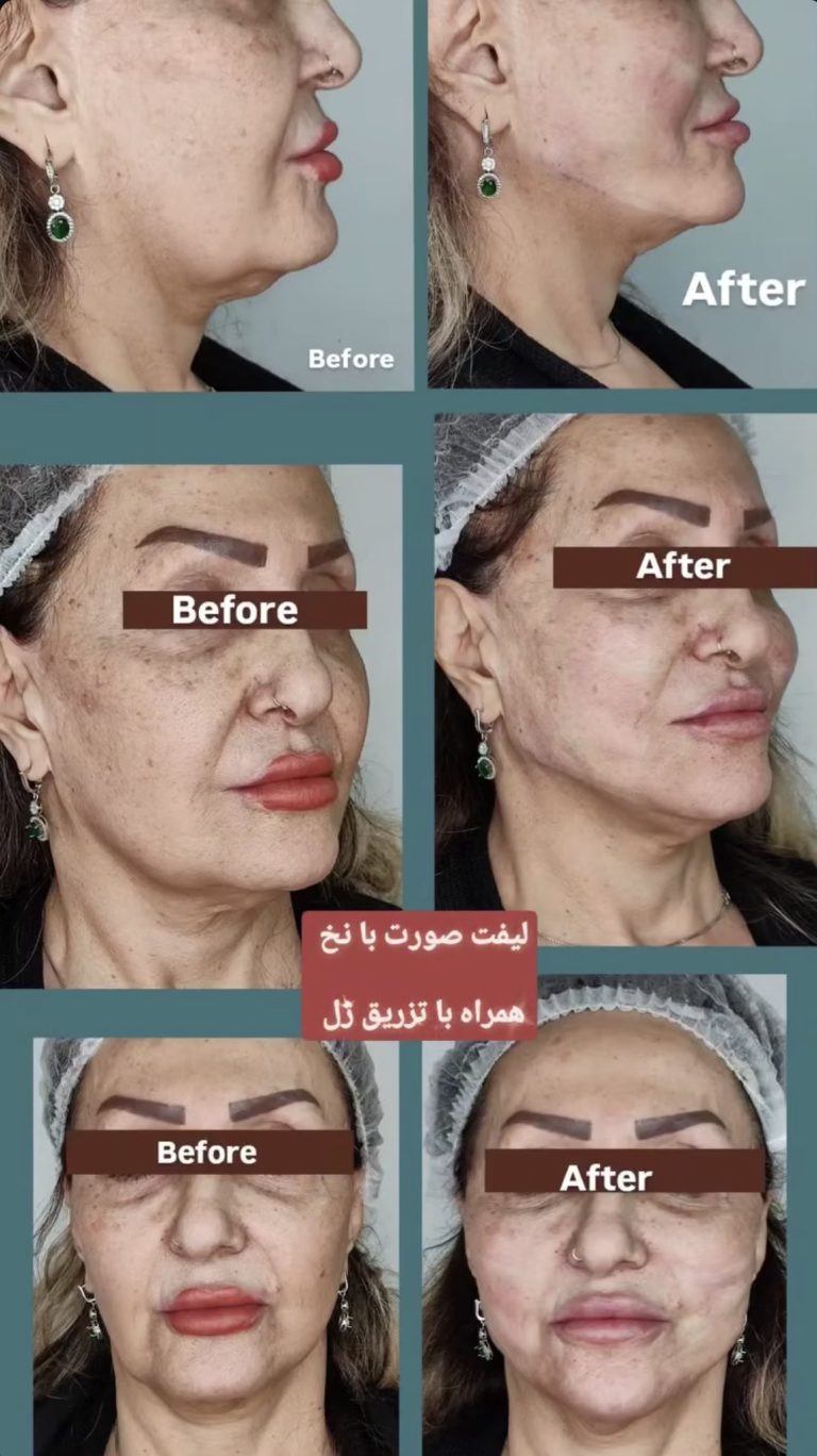 لیفت صورت با نخ در اصفهان