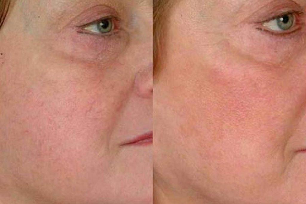 لیزر کیوسوییچ در اصفهان