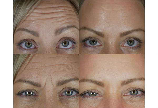 تزریق ژل و بوتاکس در اصفهان