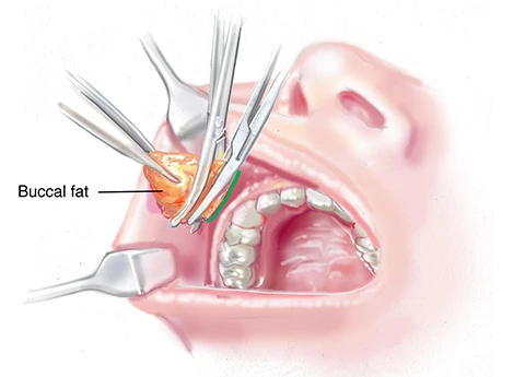 بوکال فت در اصفهان