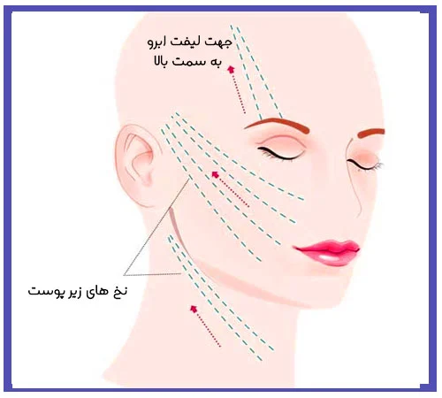 لیفت صورت با نخ در اصفهان