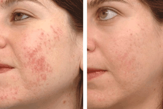 لیزر کیوسوییچ در اصفهان