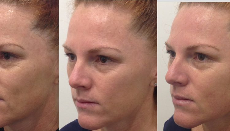 مرکز هایفوتراپی در اصفهان