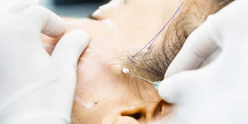 لیفت صورت با نخ در اصفهان