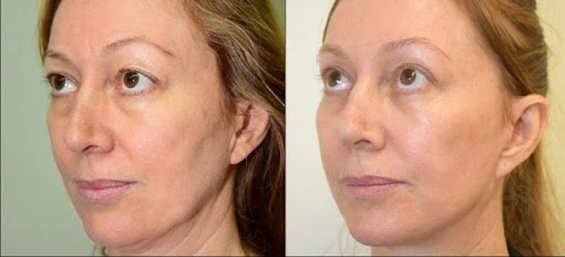 لیفت صورت با نخ در اصفهان