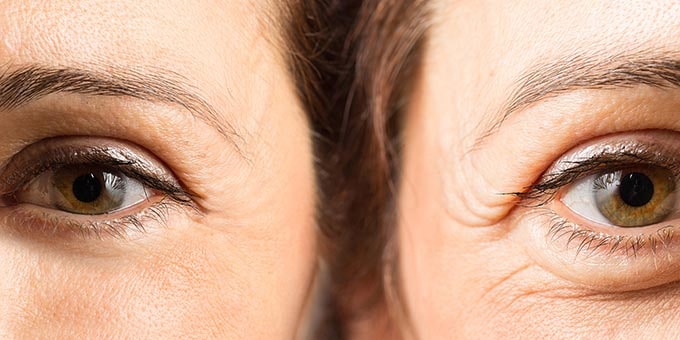 درمان افتادگی پلک در اصفهان