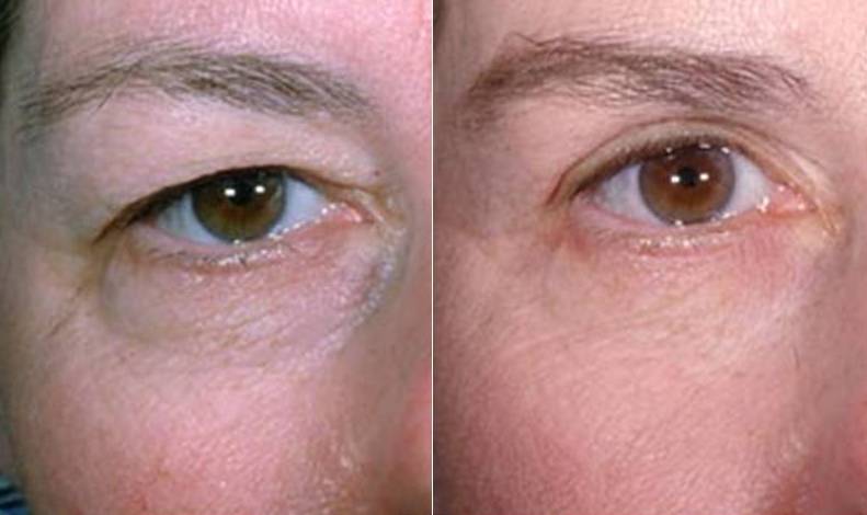 درمان افتادگی پلک در اصفهان