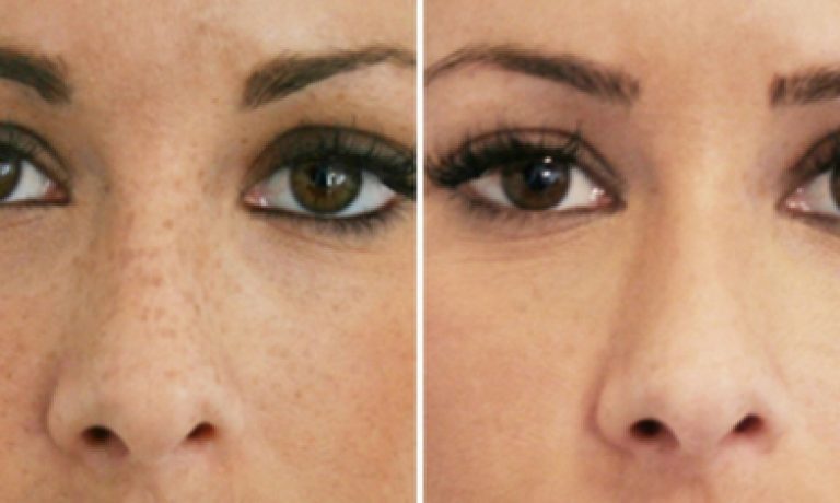 لیزر کیوسوییچ در اصفهان