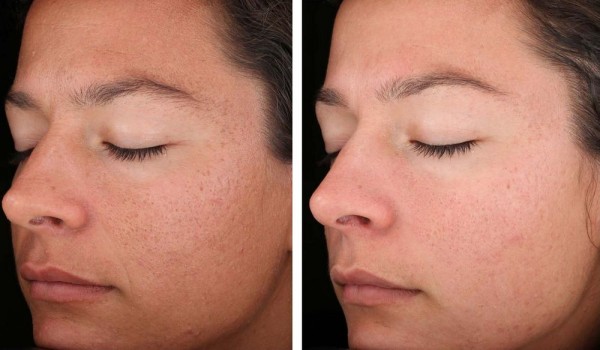 لیزر کیوسوییچ در اصفهان