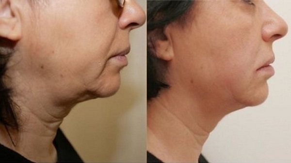 مرکز هایفوتراپی در اصفهان