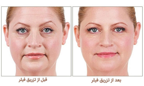 فرق فیلر با ژل و بوتاکس