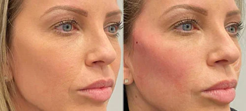 جوانسازی پوست در اصفهان