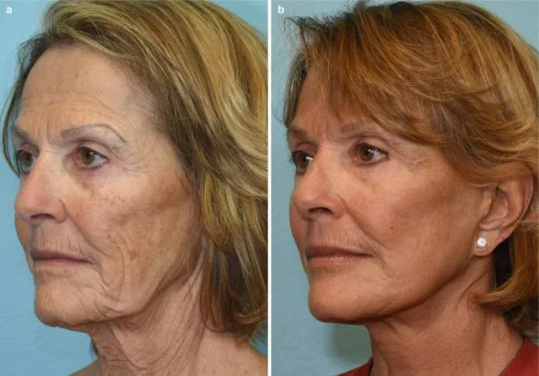 جوانسازی پوست در اصفهان