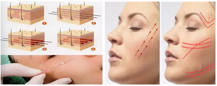 جوانسازی پوست در اصفهان