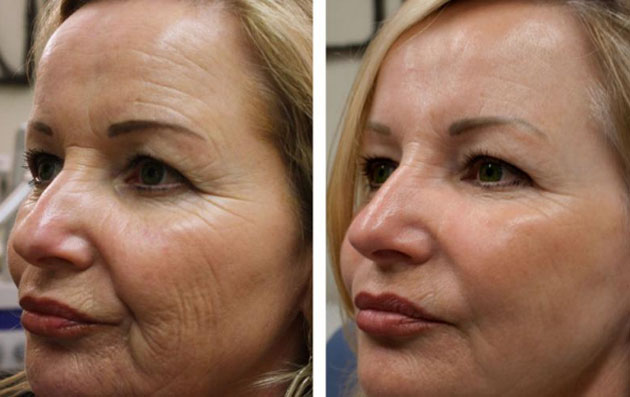 هایفوتراپی چیست