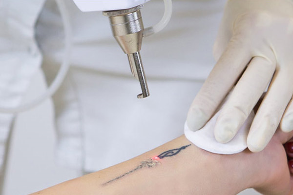 مزایا لیزر کیوسوئیچ