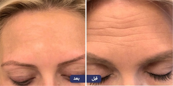 فرق فیلر با ژل و بوتاکس