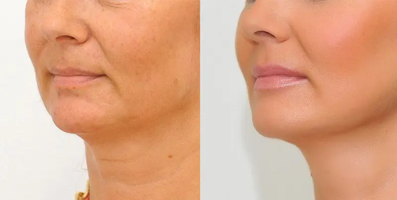 جوانسازی پوست در اصفهان