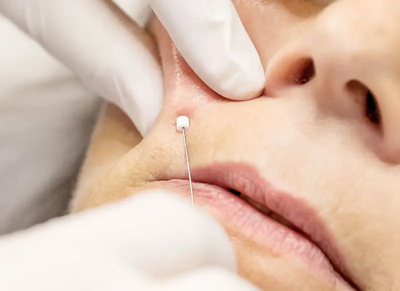 جوانسازی پوست در اصفهان