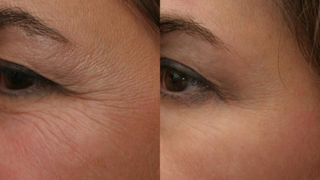 هایفوتراپی چیست