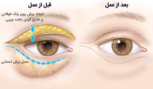 علت افتادگی پلک در جوانی