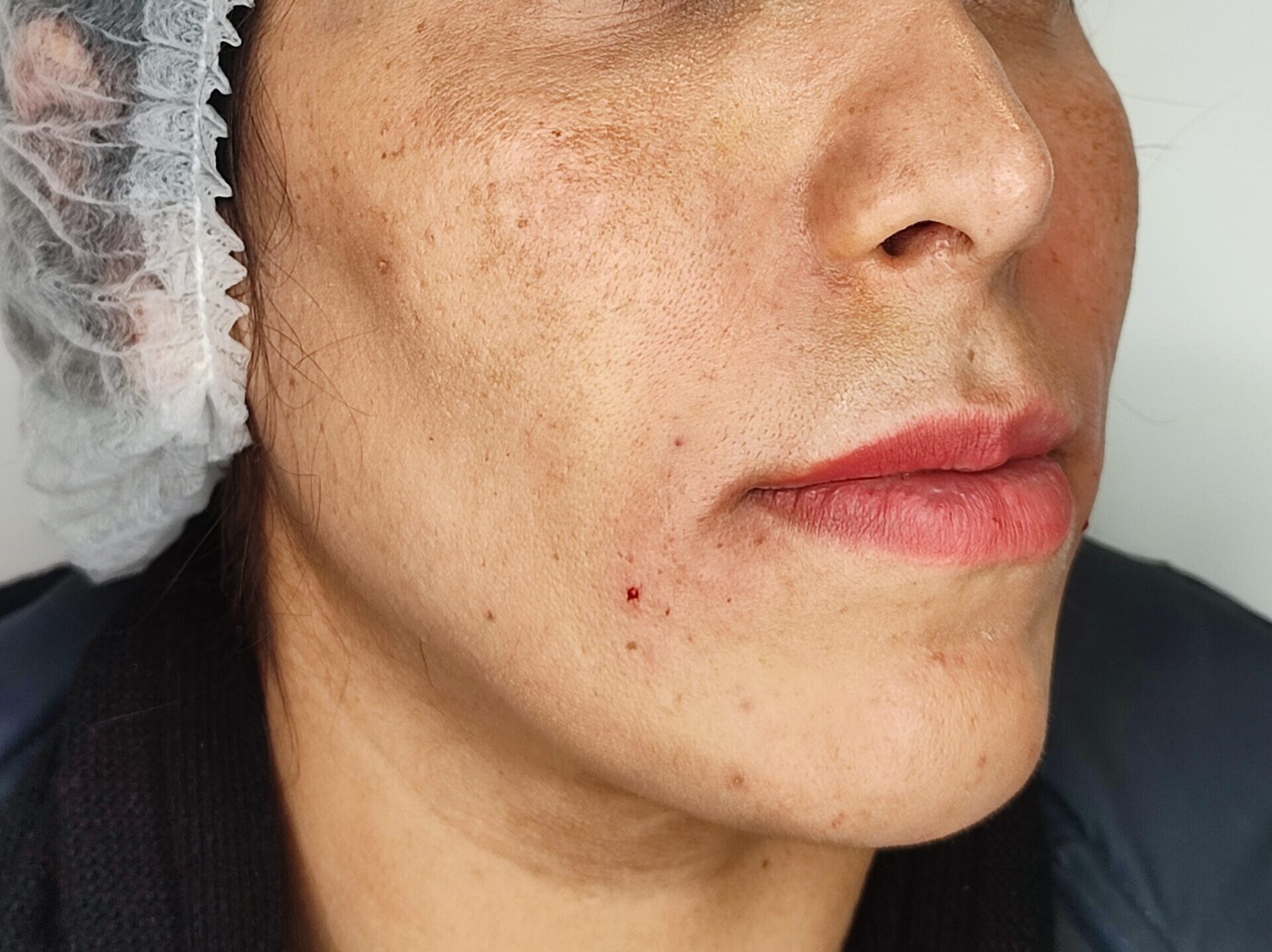 رفع خط لبحند