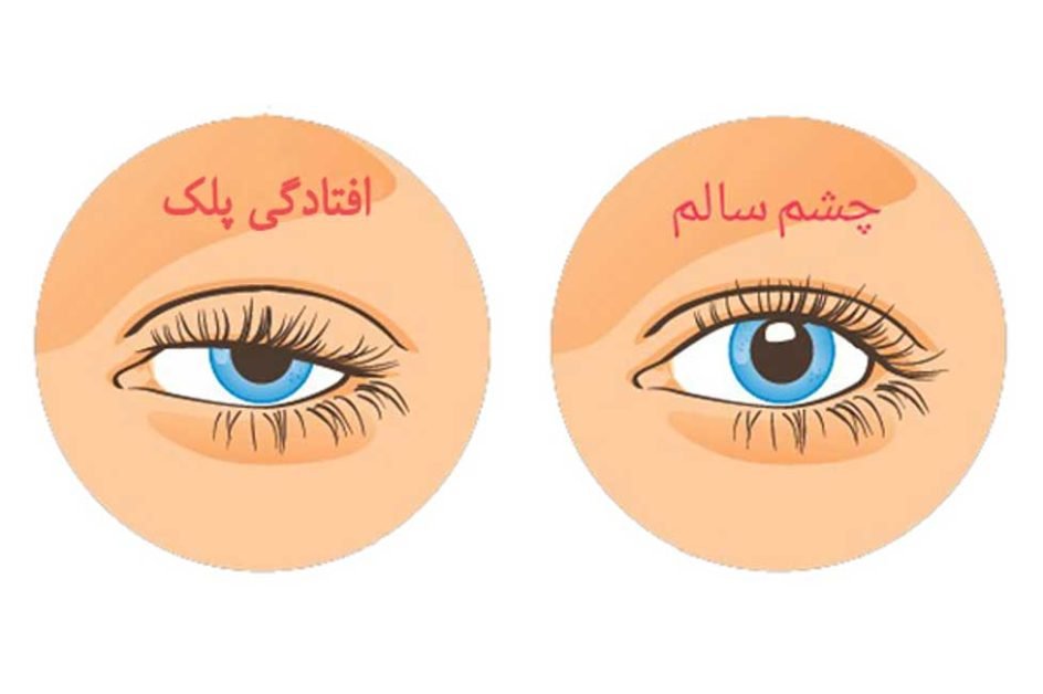 علت افتادگی پلک در جوانی