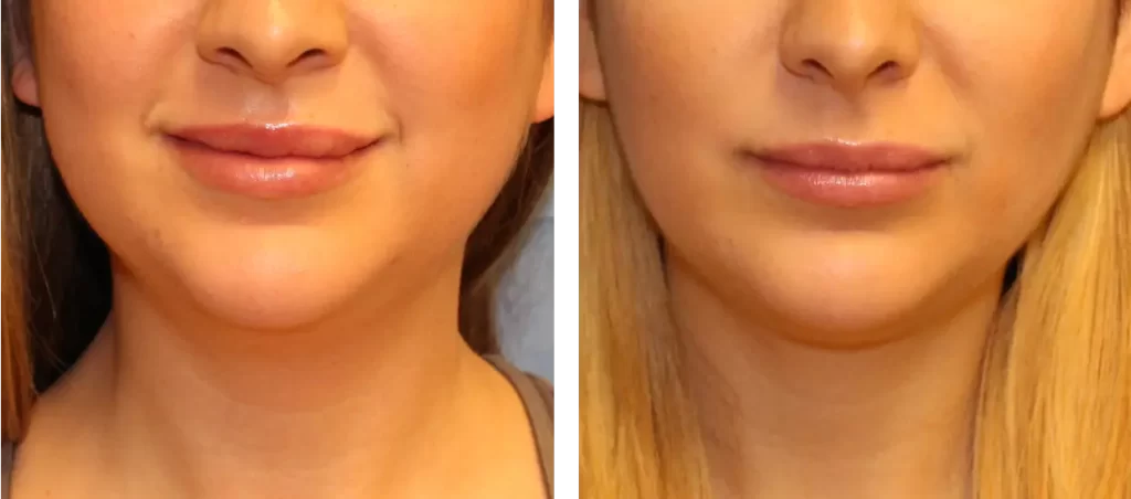 آیا جراحی بوکال فت باعث پیری می شود؟