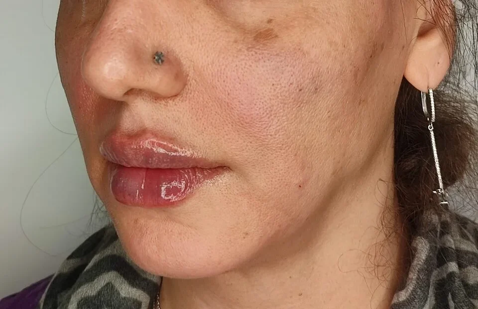 تزریق ژل لب