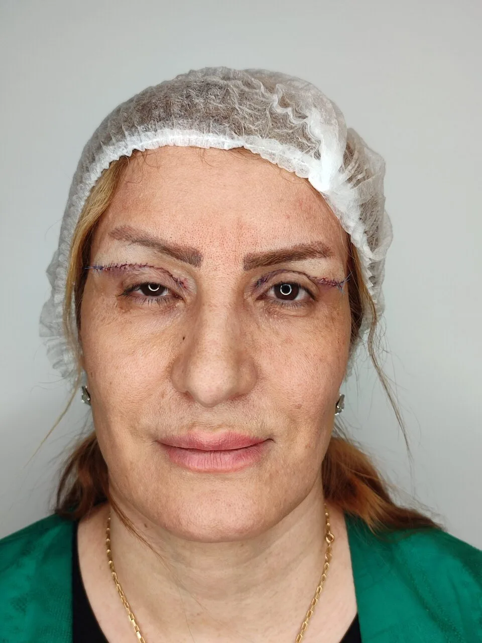 بلفاروپلاستی