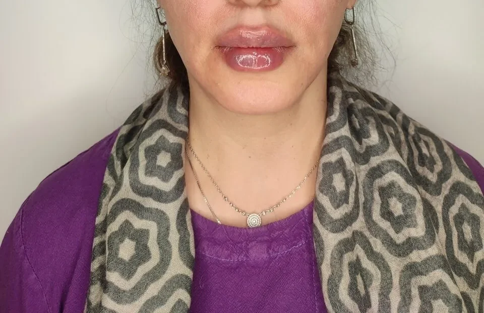 تزریق ژل لب در شاهین شهر