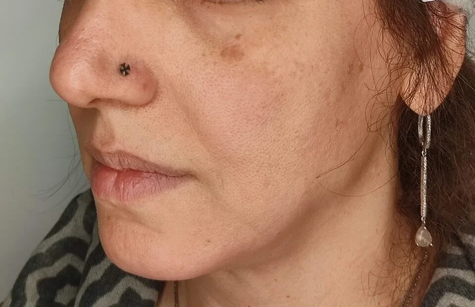 تزریق ژل لب