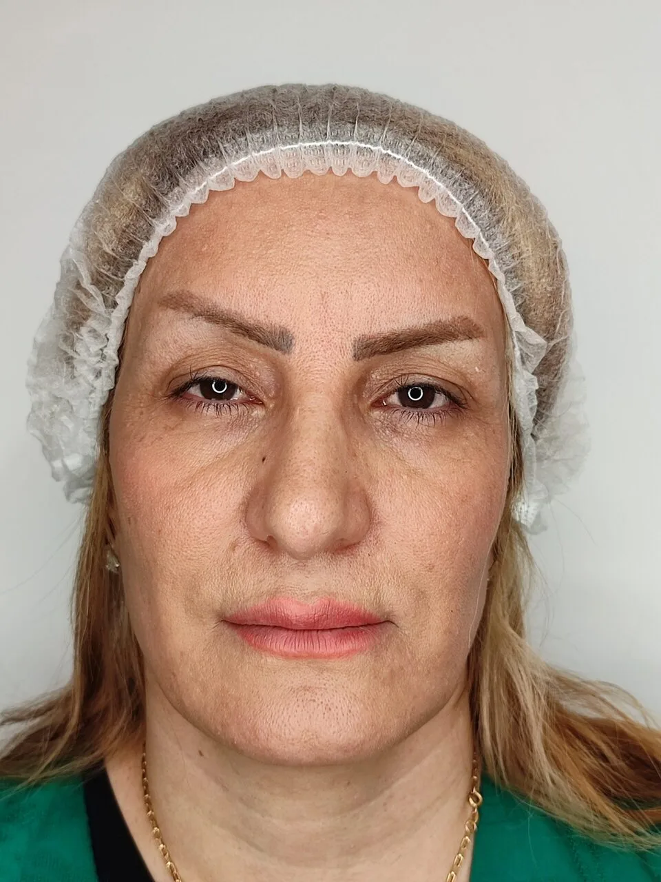 بلفاروپلاستی