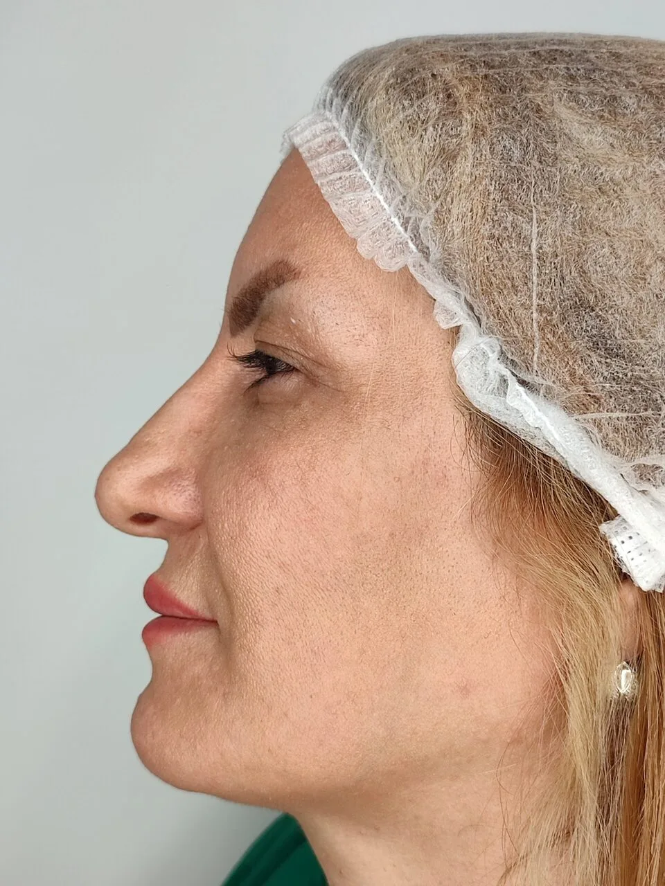 بلفاروپلاستی