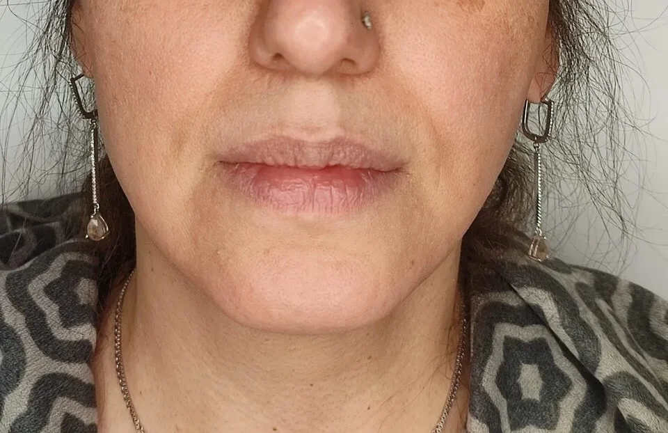 تزریق ژل لب