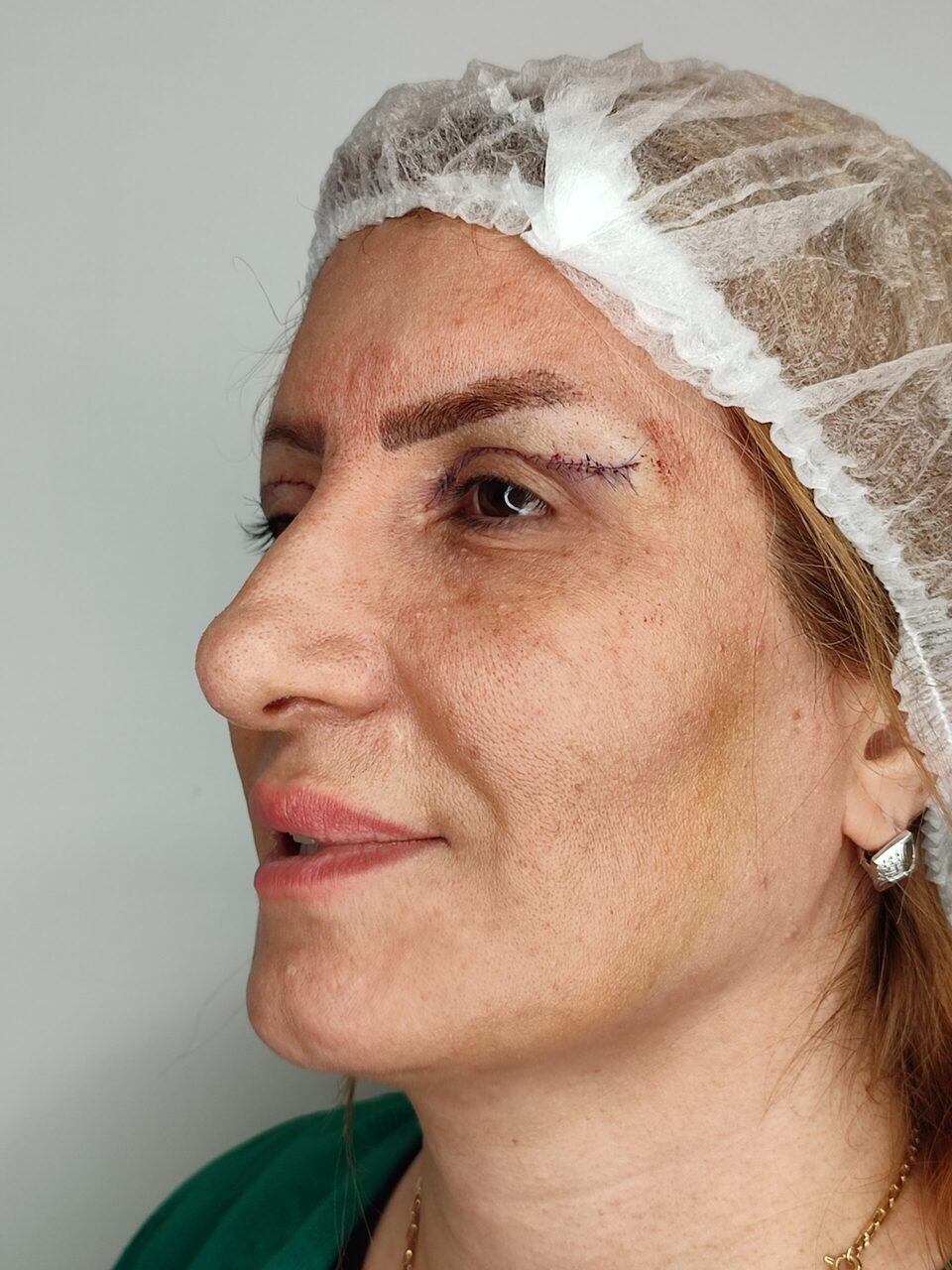 بلفاروپلاستی