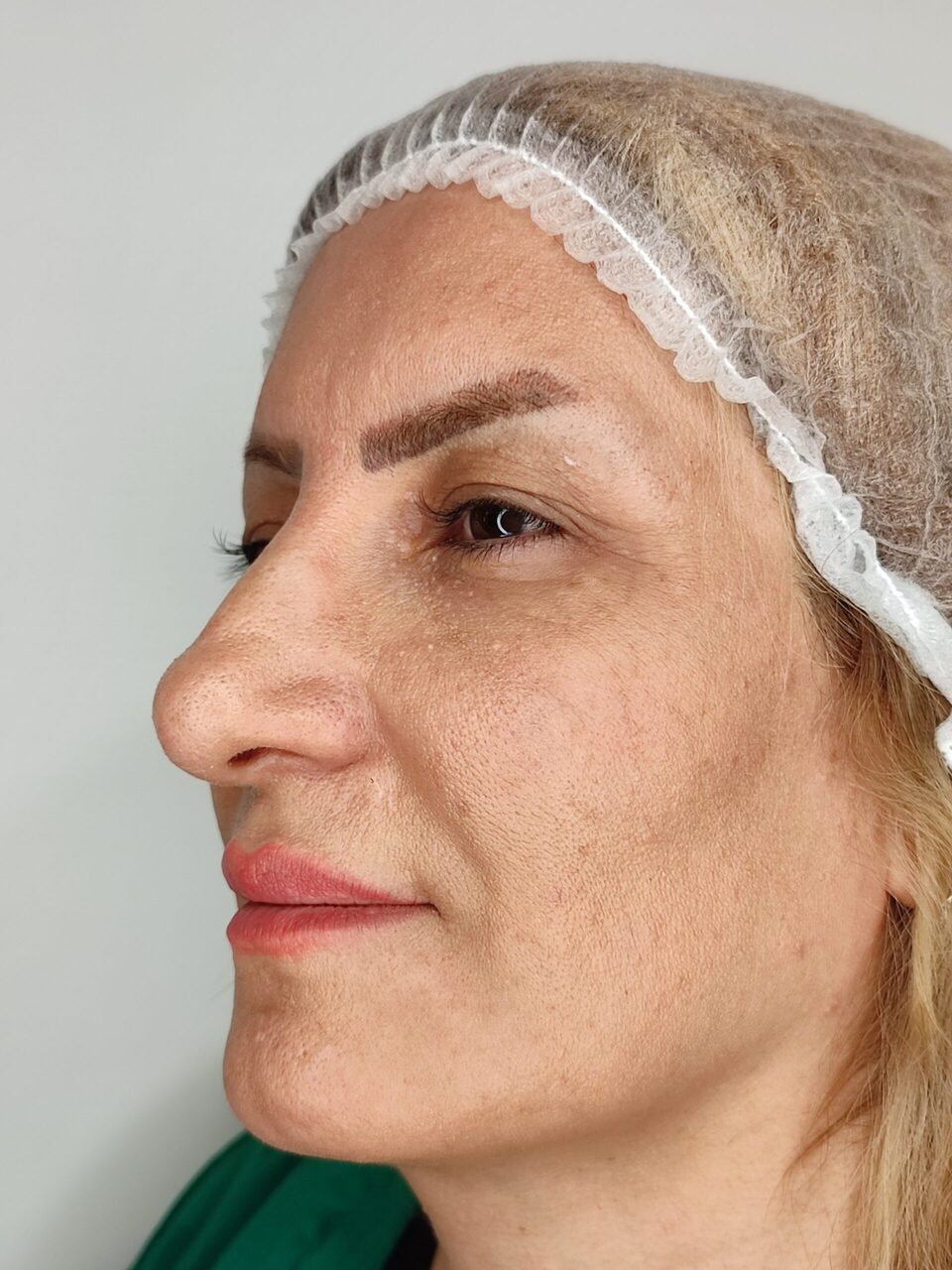 بلفاروپلاستی