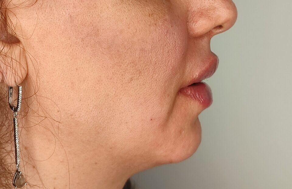 تزریق ژل لب