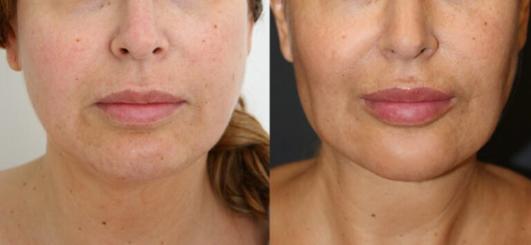 آیا جراحی بوکال فت باعث پیری می شود؟