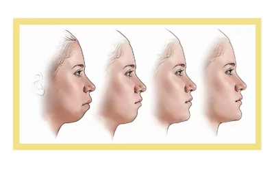 آیا جراحی بوکال فت باعث پیری می شود؟