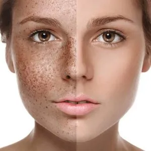 هایفوتراپی برای لک صورت